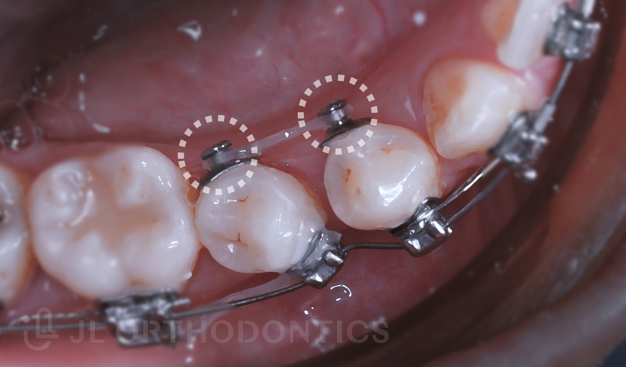 矯正裝置零件介紹- 圖說矯正｜王俊襱牙醫師