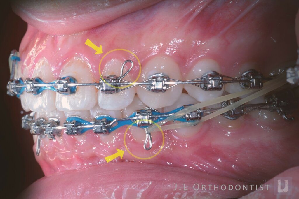 矯正器矯正線刮嘴怎麼辦 圖說矯正 王俊襱牙醫師